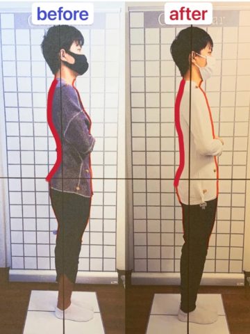 姿勢改善(反り腰)　２０代　男性