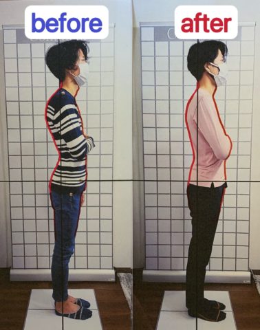 猫背&腰痛改善！　２０代　芦屋市　男性